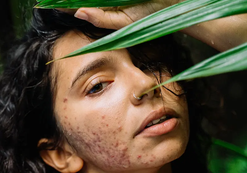 Acne-Positive Influencers Revolutionising Skin Care and Self Love Online